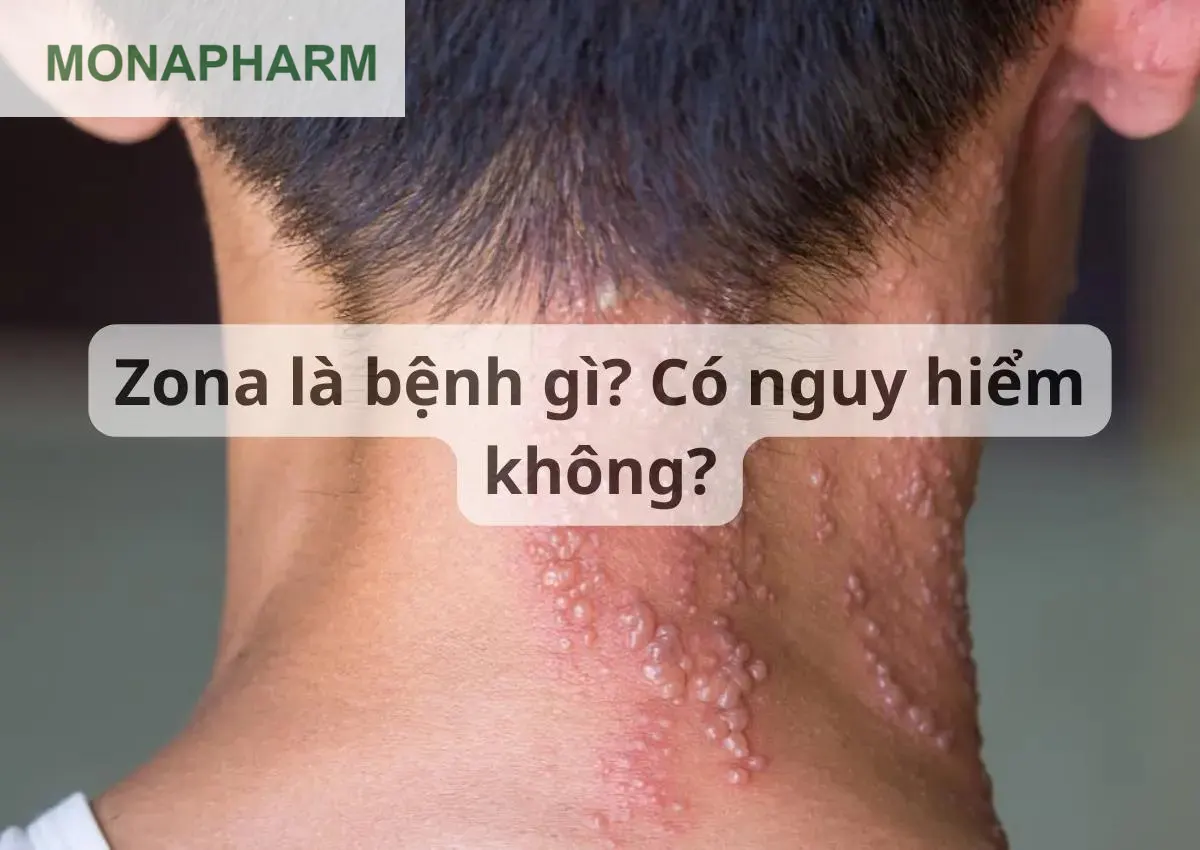 Zona là bệnh gì?