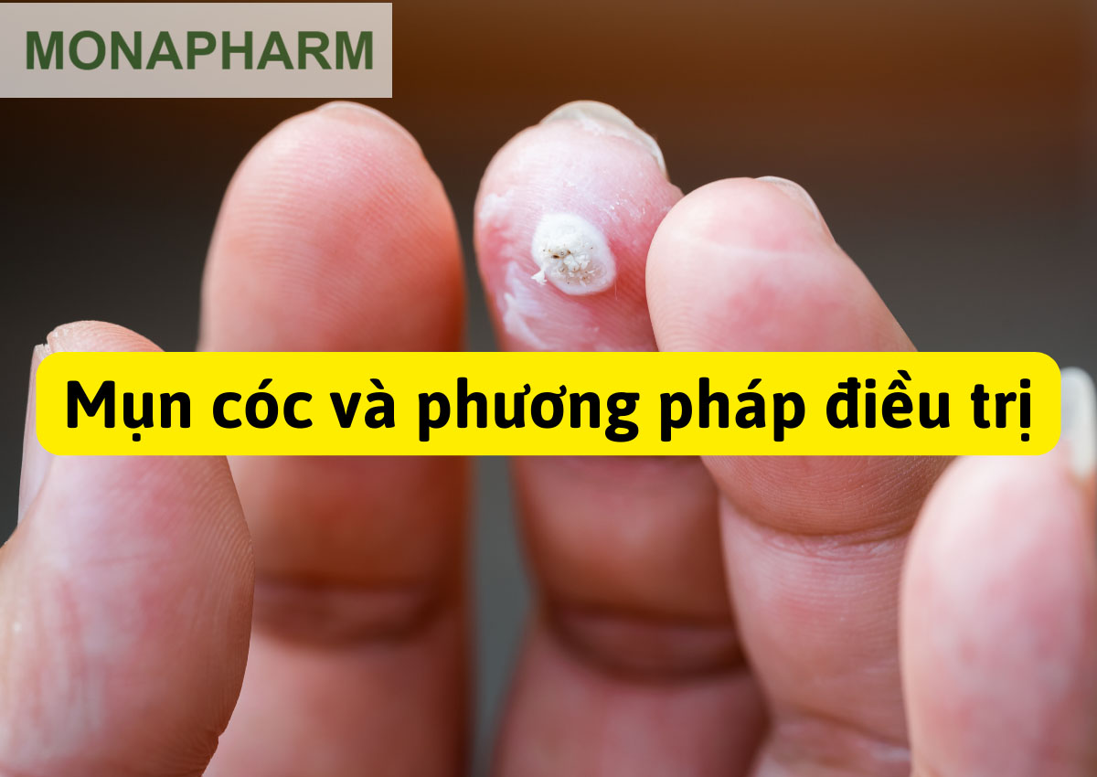 Mụn cóc và phương pháp điều trị