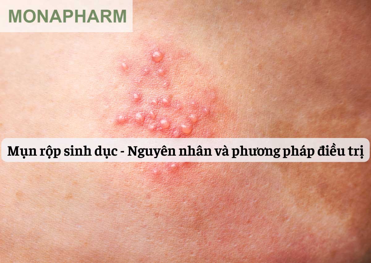 Mụn rộp sinh dục - Nguyên nhân và phương pháp điều trị