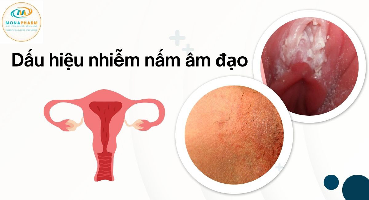 Dấu hiệu nhiễm nấm âm đạo